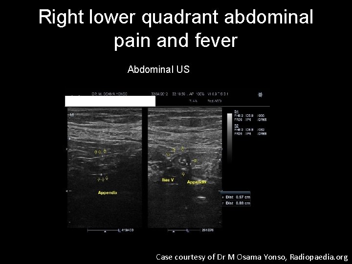 Right lower quadrant abdominal pain and fever Abdominal US Case courtesy of Dr M