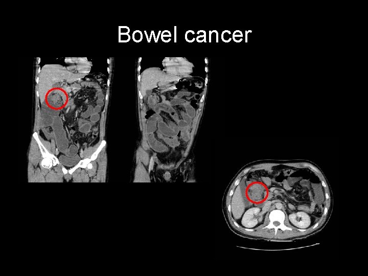 Bowel cancer 