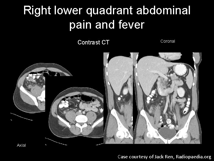 Right lower quadrant abdominal pain and fever Contrast CT Coronal Axial Case courtesy of