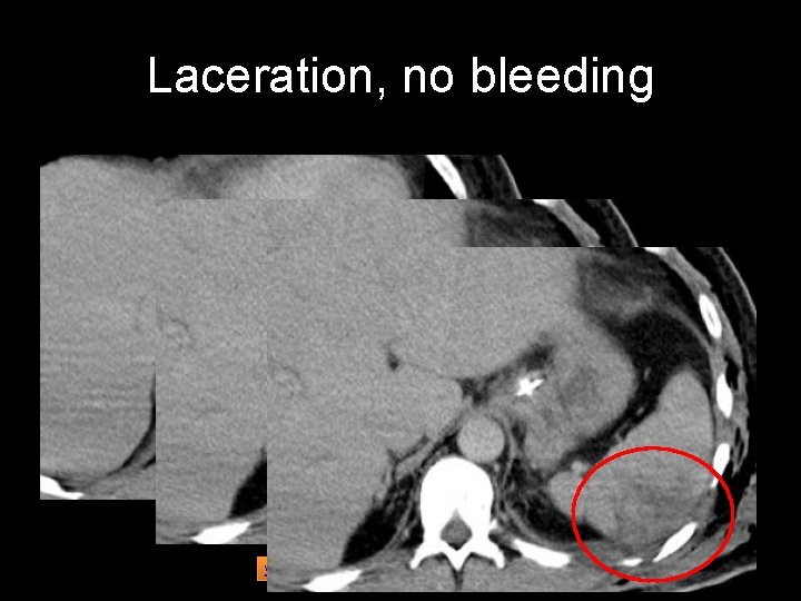 Laceration, no bleeding www. radiologyassistant. nl CT in trauma 