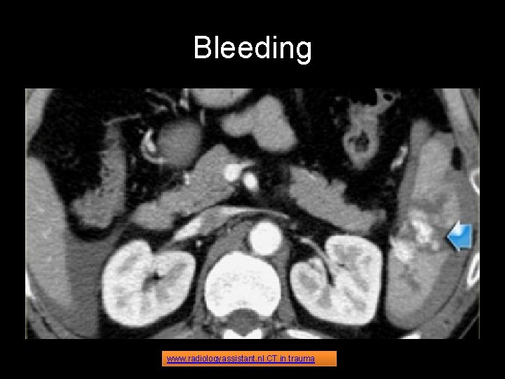 Bleeding www. radiologyassistant. nl CT in trauma 