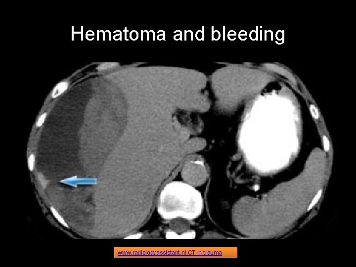 Hematoma and bleeding www. radiologyassistant. nl CT in trauma 