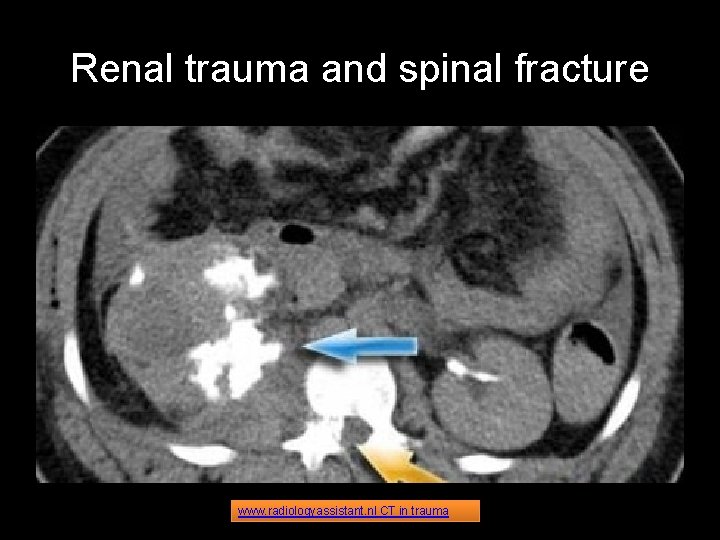 Renal trauma and spinal fracture www. radiologyassistant. nl CT in trauma 