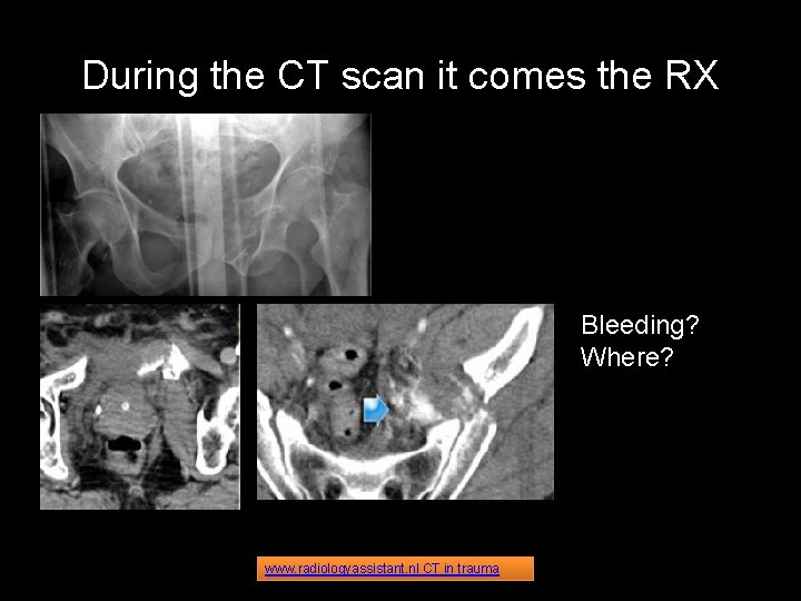 During the CT scan it comes the RX Bleeding? Where? www. radiologyassistant. nl CT