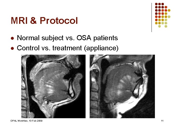 MRI & Protocol l l Normal subject vs. OSA patients Control vs. treatment (appliance)