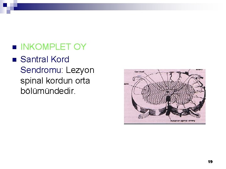 n n INKOMPLET OY Santral Kord Sendromu: Lezyon spinal kordun orta bölümündedir. 19 