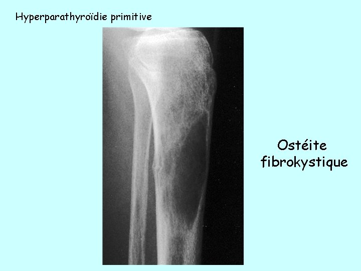 Hyperparathyroïdie primitive Ostéite fibrokystique 