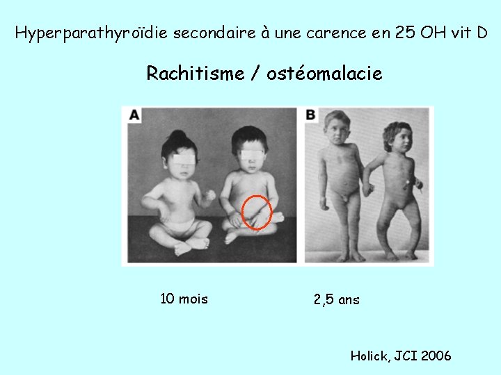 Hyperparathyroïdie secondaire à une carence en 25 OH vit D Rachitisme / ostéomalacie 10