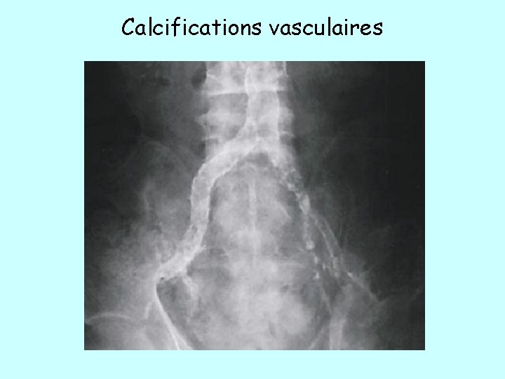 Calcifications vasculaires 