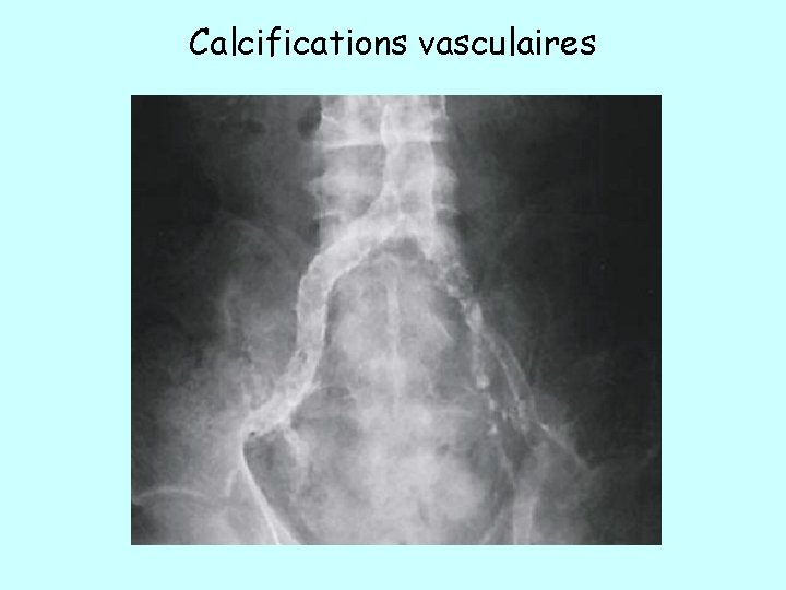 Calcifications vasculaires Calcifications vasculaires