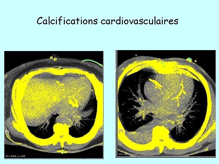Calcifications cardiovasculaires 