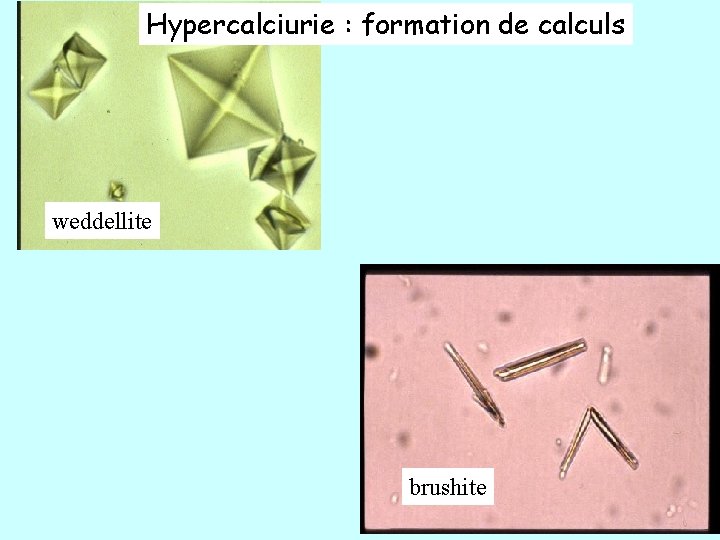 Hypercalciurie : formation de calculs weddellite brushite 