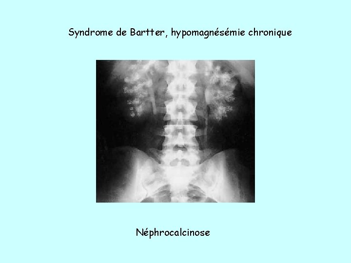 Syndrome de Bartter, hypomagnésémie chronique Néphrocalcinose 