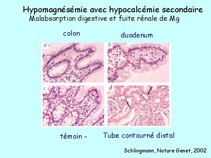 Hypomagnésémie avec hypocalcémie secondaire Malabsorption digestive et fuite rénale de Mg colon duodenum témoin