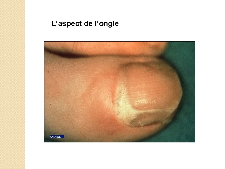 L’aspect de l’ongle 