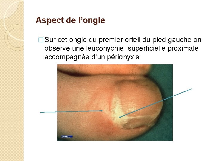 Aspect de l’ongle � Sur cet ongle du premier orteil du pied gauche on
