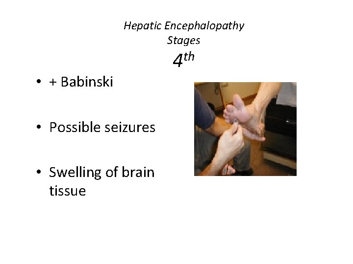 Hepatic Encephalopathy Stages • + Babinski • Possible seizures • Swelling of brain tissue