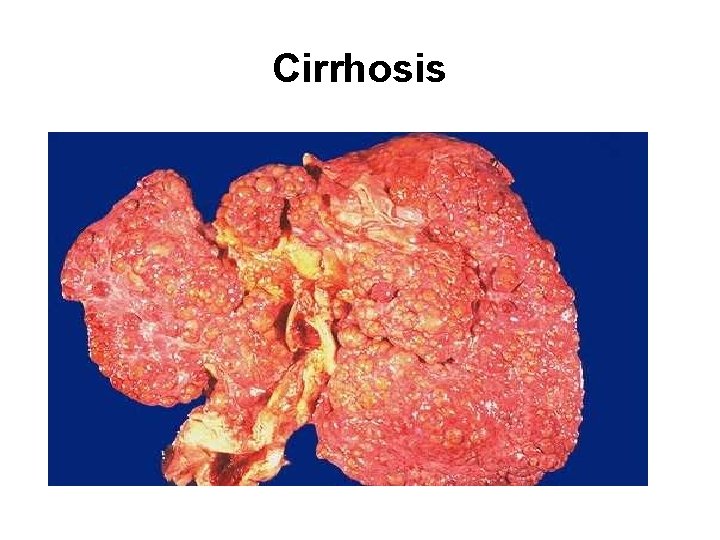 Cirrhosis 