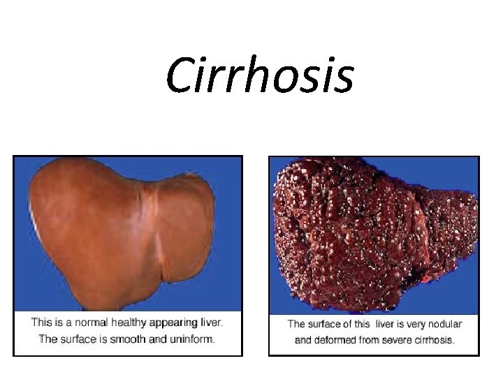 Cirrhosis 