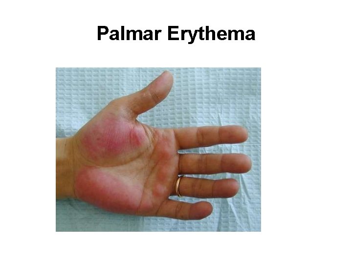 Palmar Erythema 