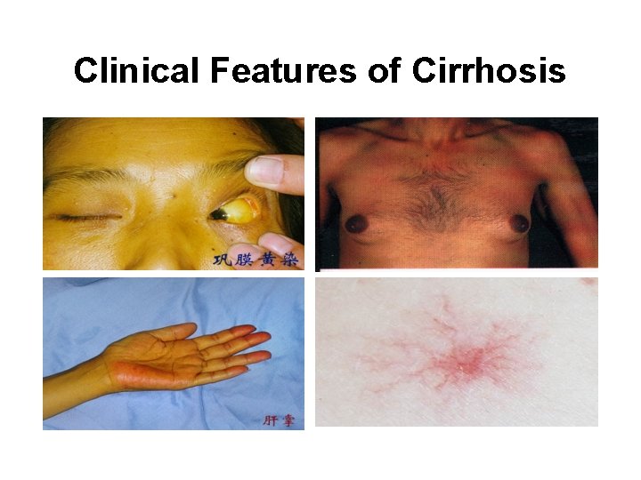 Clinical Features of Cirrhosis 