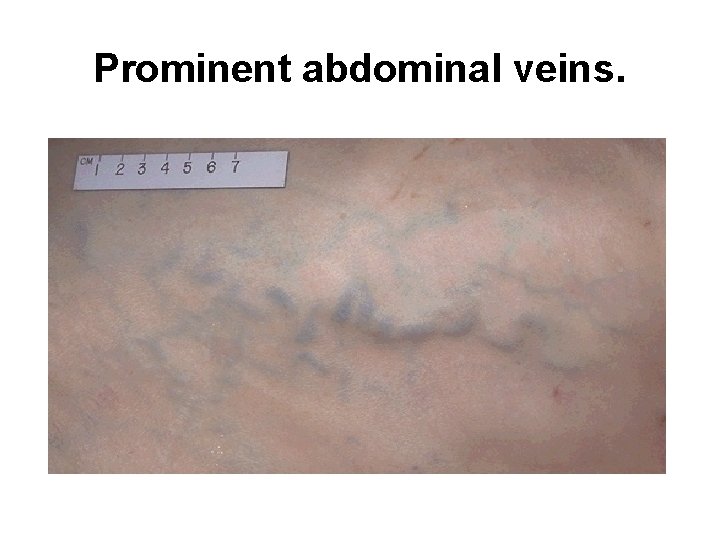 Prominent abdominal veins. 