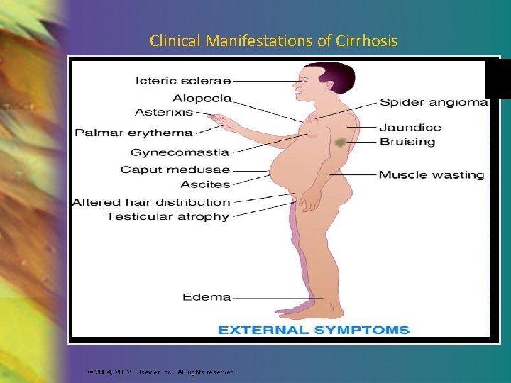 Clinical Manifestations of Cirrhosis © 2004, 2002 Elsevier Inc. All rights reserved. 