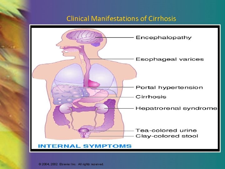 Clinical Manifestations of Cirrhosis © 2004, 2002 Elsevier Inc. All rights reserved. 