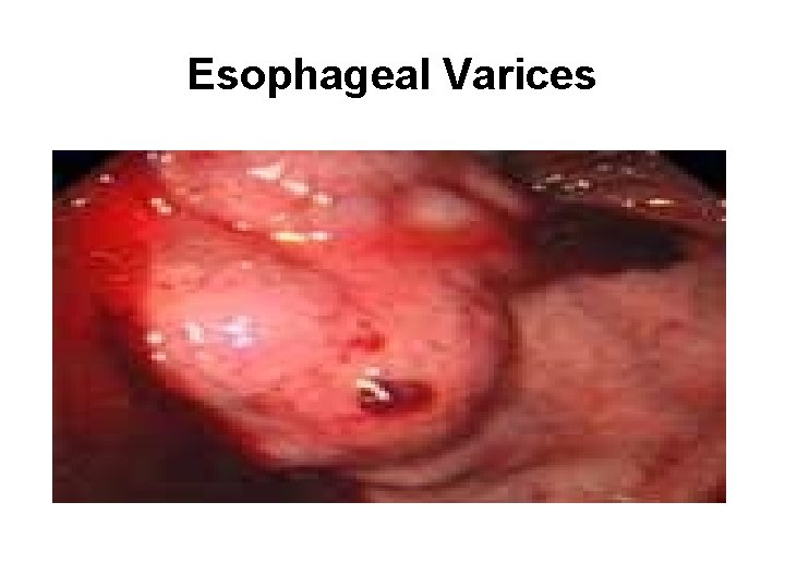 Esophageal Varices 