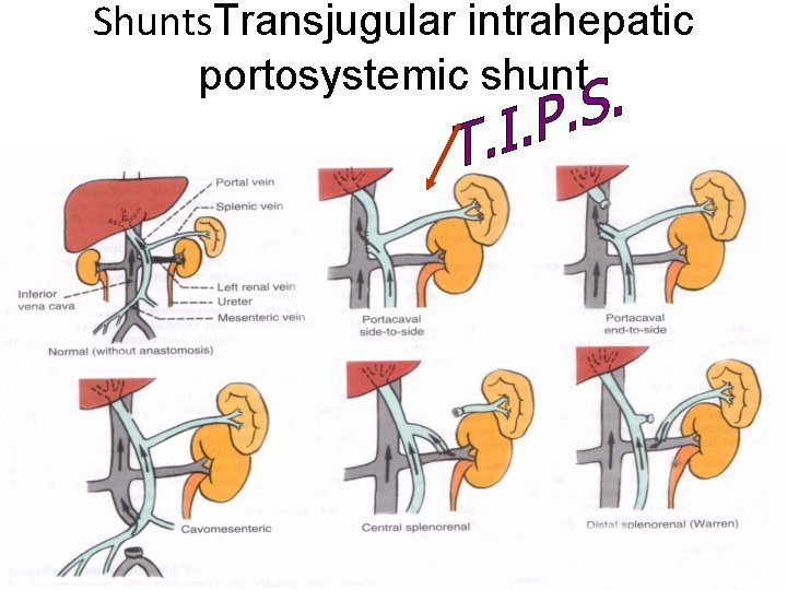 Shunts. Transjugular intrahepatic portosystemic shunt 