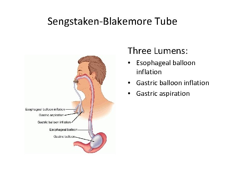 Sengstaken-Blakemore Tube Three Lumens: • Esophageal balloon inflation • Gastric aspiration 
