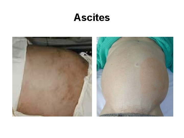 Ascites 