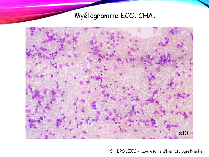 Myélogramme ECO. CHA. x 10 Ch. BROUZES - laboratoire d’Hématologie Necker Myélogramme ECO. CHA. x 10 Ch. BROUZES - laboratoire d’Hématologie Necker