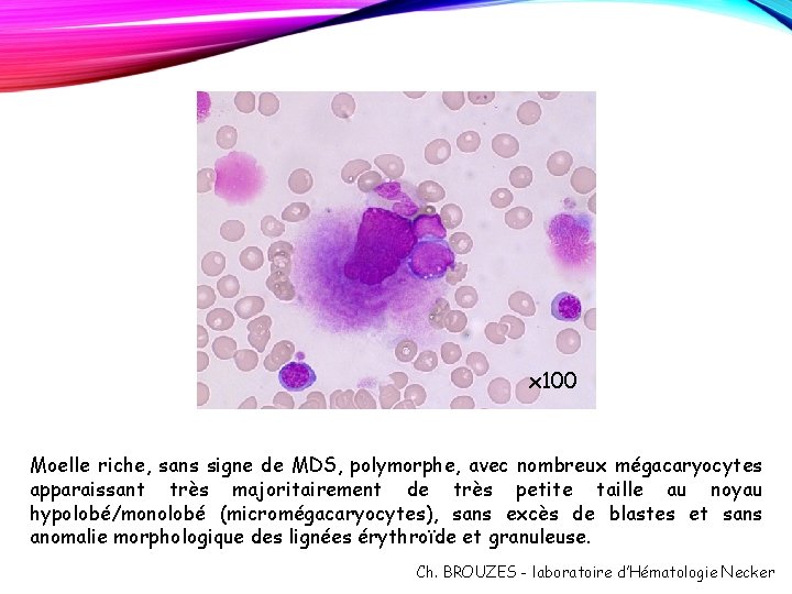 x 100 Moelle riche, sans signe de MDS, polymorphe, avec nombreux mégacaryocytes apparaissant très x 100 Moelle riche, sans signe de MDS, polymorphe, avec nombreux mégacaryocytes apparaissant très