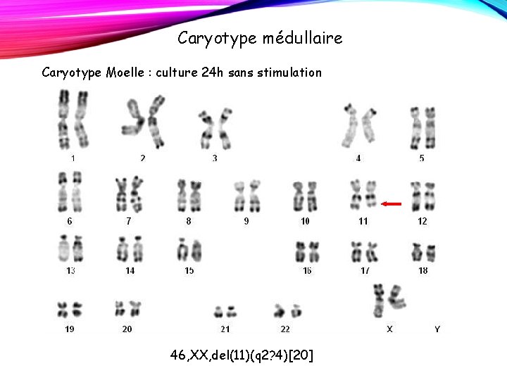 Caryotype médullaire Caryotype Moelle : culture 24 h sans stimulation 46, XX, del(11)(q 2? Caryotype médullaire Caryotype Moelle : culture 24 h sans stimulation 46, XX, del(11)(q 2?