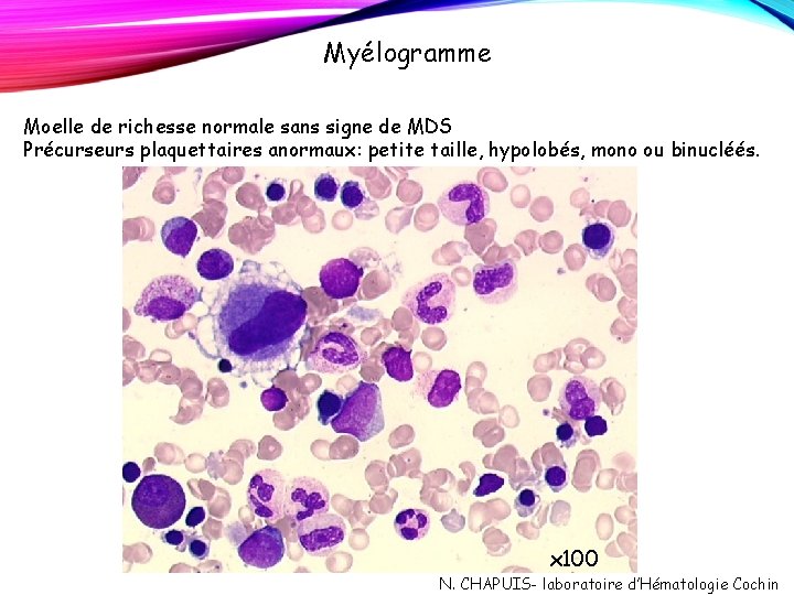 Myélogramme Moelle de richesse normale sans signe de MDS Précurseurs plaquettaires anormaux: petite taille, Myélogramme Moelle de richesse normale sans signe de MDS Précurseurs plaquettaires anormaux: petite taille,