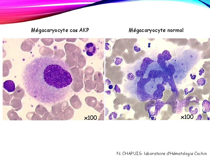 Mégacaryocyte cas AKP x 100 Mégacaryocyte normal x 100 N. CHAPUIS- laboratoire d’Hématologie Cochin Mégacaryocyte cas AKP x 100 Mégacaryocyte normal x 100 N. CHAPUIS- laboratoire d’Hématologie Cochin