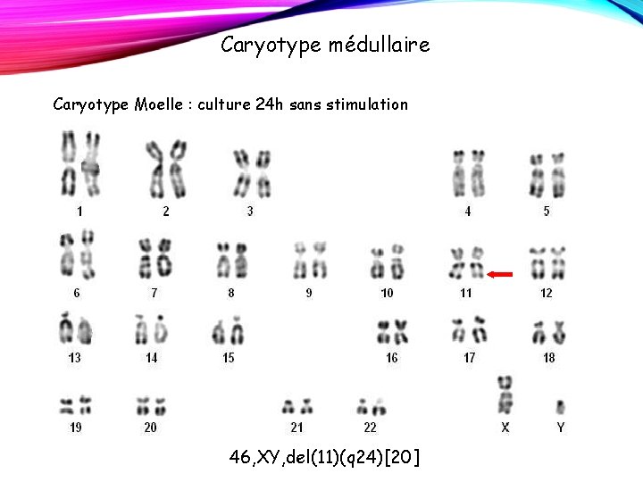 Caryotype médullaire Caryotype Moelle : culture 24 h sans stimulation 46, XY, del(11)(q 24)[20]