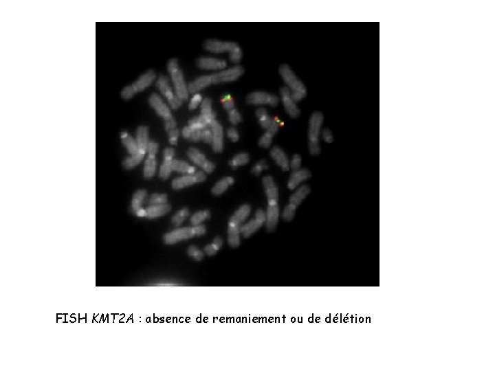FISH KMT 2 A : absence de remaniement ou de délétion FISH KMT 2 A : absence de remaniement ou de délétion