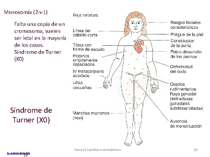 Monosomía (2 n-1) Falta una copia de un cromosoma, suelen ser letal en la