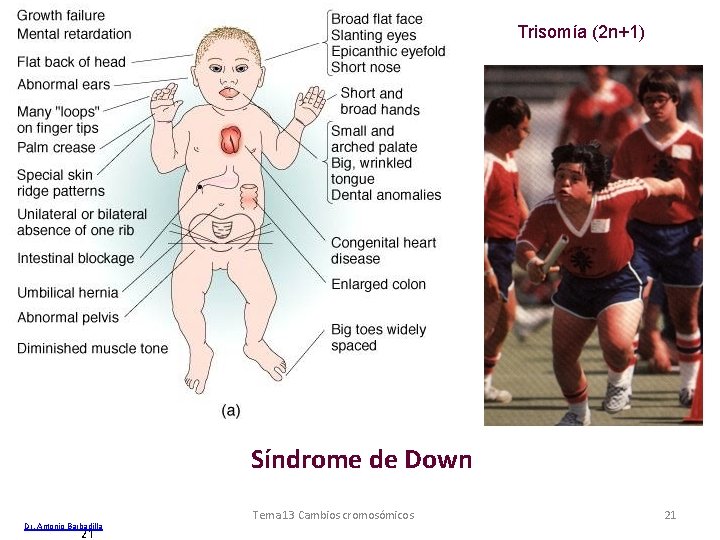 Trisomía (2 n+1) Síndrome de Down Dr. Antonio Barbadilla 21 Tema 13 Cambios cromosómicos Trisomía (2 n+1) Síndrome de Down Dr. Antonio Barbadilla 21 Tema 13 Cambios cromosómicos