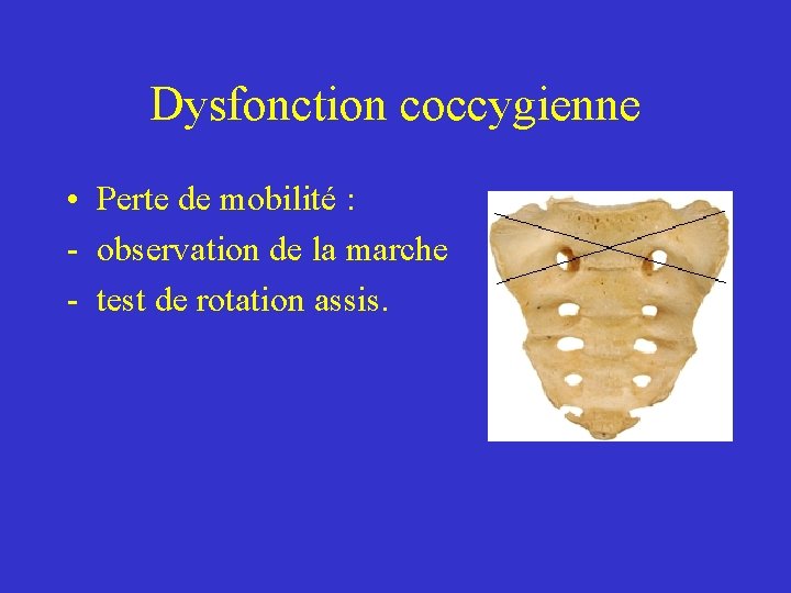 Dysfonction coccygienne • Perte de mobilité : - observation de la marche - test Dysfonction coccygienne • Perte de mobilité : - observation de la marche - test