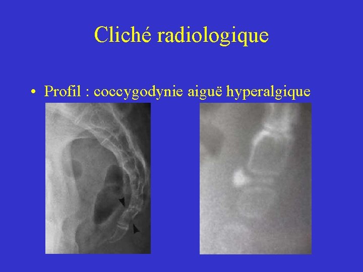 Cliché radiologique • Profil : coccygodynie aiguë hyperalgique Cliché radiologique • Profil : coccygodynie aiguë hyperalgique