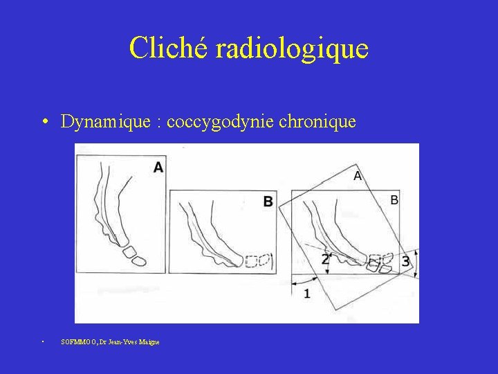 Cliché radiologique • Dynamique : coccygodynie chronique • SOFMMOO, Dr Jean-Yves Maigne Cliché radiologique • Dynamique : coccygodynie chronique • SOFMMOO, Dr Jean-Yves Maigne