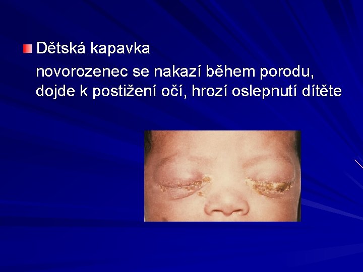 Dětská kapavka novorozenec se nakazí během porodu, dojde k postižení očí, hrozí oslepnutí dítěte