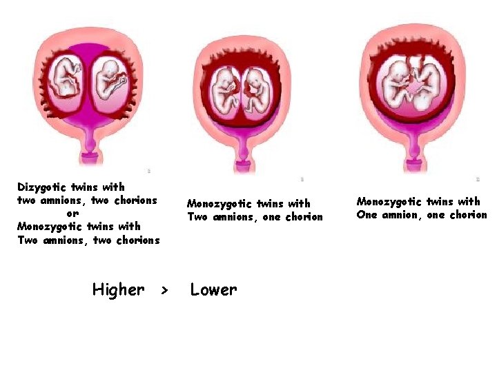 Dizygotic twins with two amnions, two chorions or Monozygotic twins with Two amnions, two