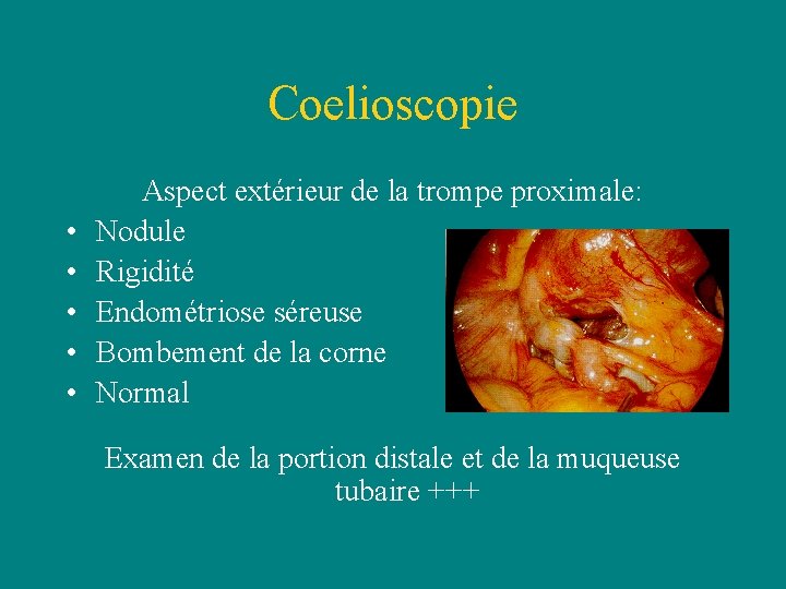 Coelioscopie • • • Aspect extérieur de la trompe proximale: Nodule Rigidité Endométriose séreuse Coelioscopie • • • Aspect extérieur de la trompe proximale: Nodule Rigidité Endométriose séreuse