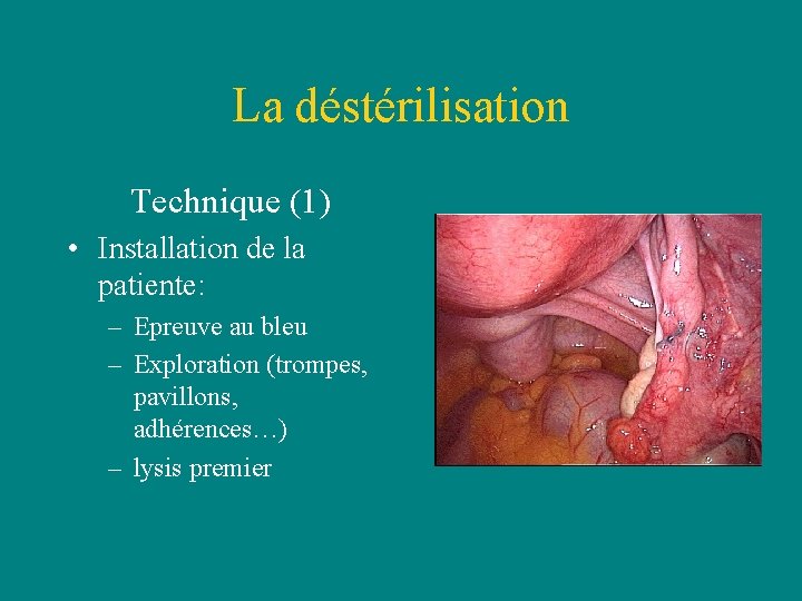 La déstérilisation Technique (1) • Installation de la patiente: – Epreuve au bleu – La déstérilisation Technique (1) • Installation de la patiente: – Epreuve au bleu –