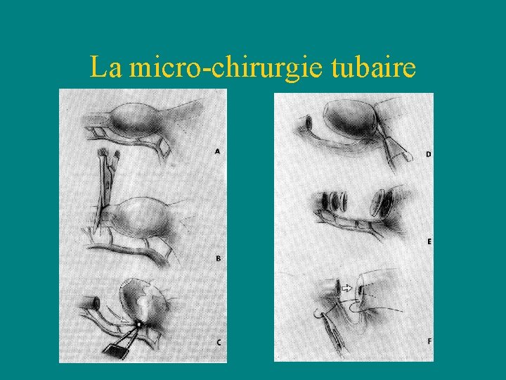 La micro-chirurgie tubaire • La micro-chirurgie tubaire •
