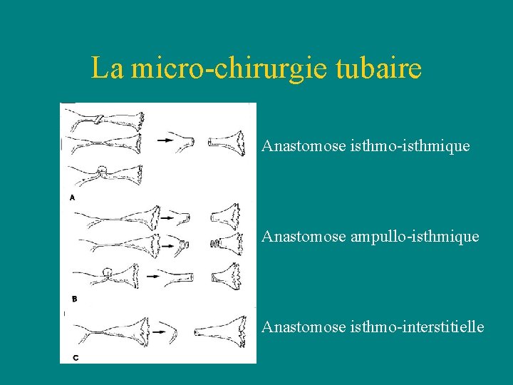 La micro-chirurgie tubaire Anastomose isthmo-isthmique Anastomose ampullo-isthmique Anastomose isthmo-interstitielle La micro-chirurgie tubaire Anastomose isthmo-isthmique Anastomose ampullo-isthmique Anastomose isthmo-interstitielle